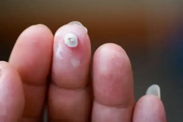 Image of white wart before cryopen treatment Wilmslow