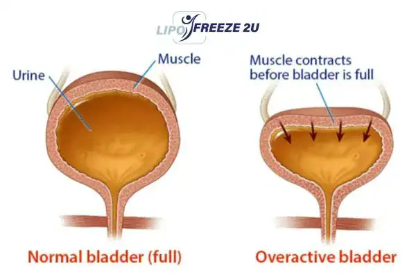 diagram of overactive bladder treatment Wilmslow
