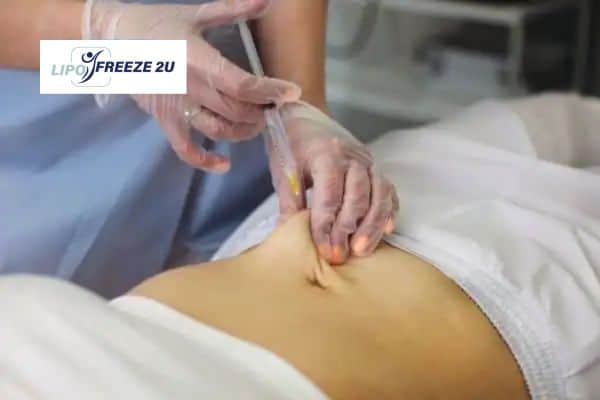 How Does Aqualyx Fat Dissolving Injection Work to Break Down Fat Wilmslow?