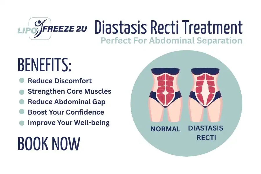 Benefits of body toning treatment Wilmslow for Diastasis recti