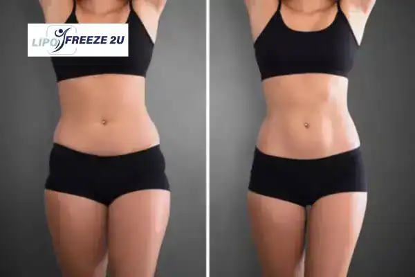 How Can LIPO FREEZE 2U Support Your Post-Pregnancy Body Recovery Wilmslow?
