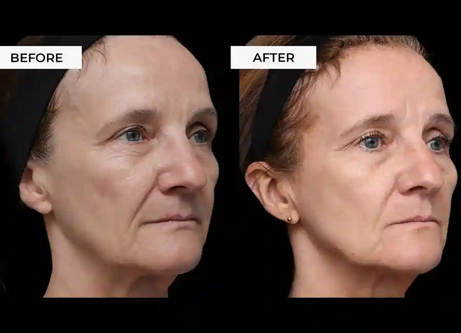 How Many RF Microneedling Sessions Will You Need to See a Difference Wilmslow?