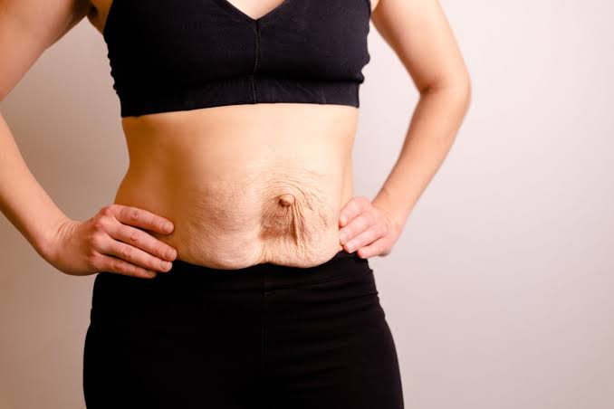 Is Surgery Really the Only Way to Repair Diastasis Recti Wilmslow?