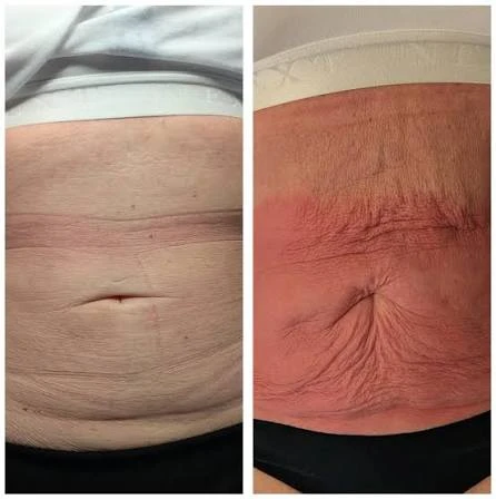 How Does RF Microneedling Improve Crepey, Thin and Uneven Skin Texture Wilmslow?