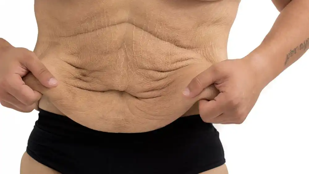 Why Does Weight Loss Medication Leave Some People With Loose or Sagging Skin Wilmslow?